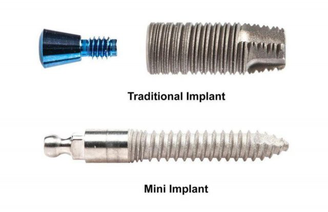 Implantati
